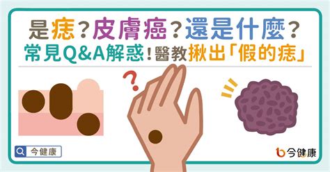 為什麼會長痣|是痣？皮膚癌？還是什麼？常見Q&A解惑！醫教揪出「假的痣」